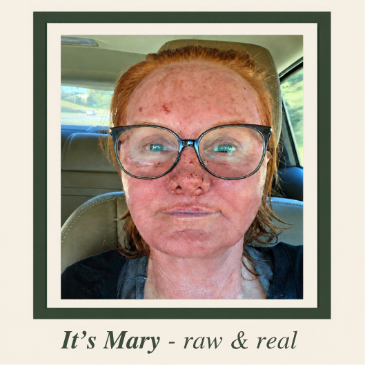 Why Didn't My Microneedling Work?